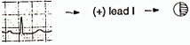 Lead 1 - positive depolarisation