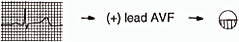 Lead AVF - positive depolarisation