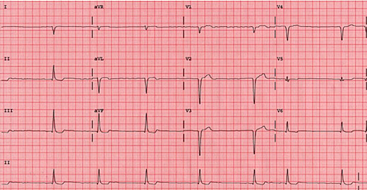 right axis deviation