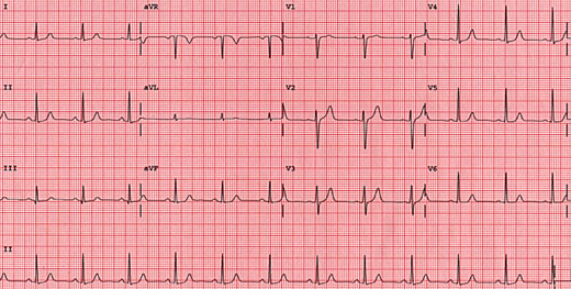 Normal Axis trace
