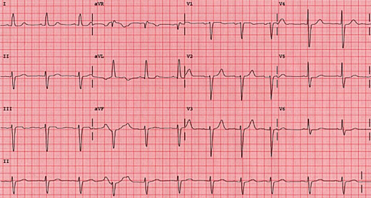 Left axis deviation