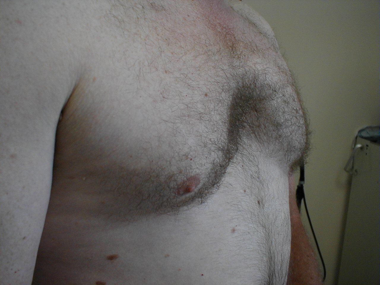 Pectus Excavatum